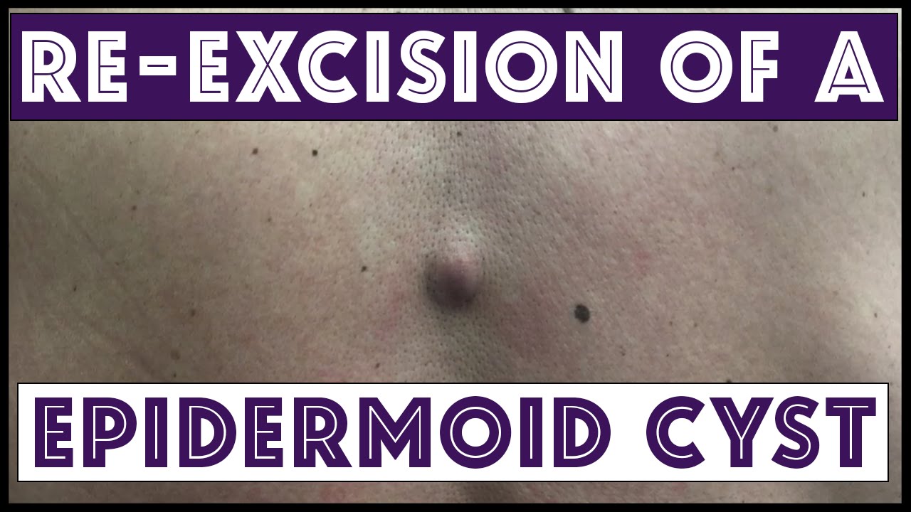 Re-Excision of a Cyst on the Lower Back