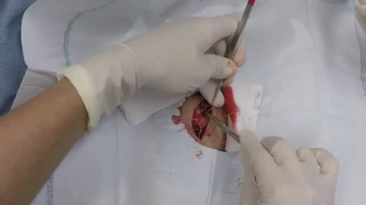 Re-upload – Derm surgery: excision of basal cell carcinoma For medical education- NSFE.