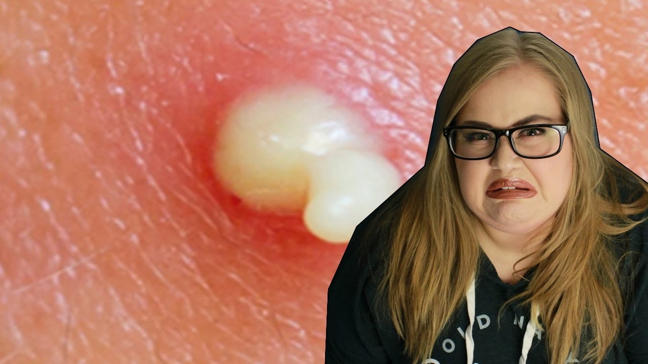 REACTING TO PIMPLE POPPING VIDEOS!