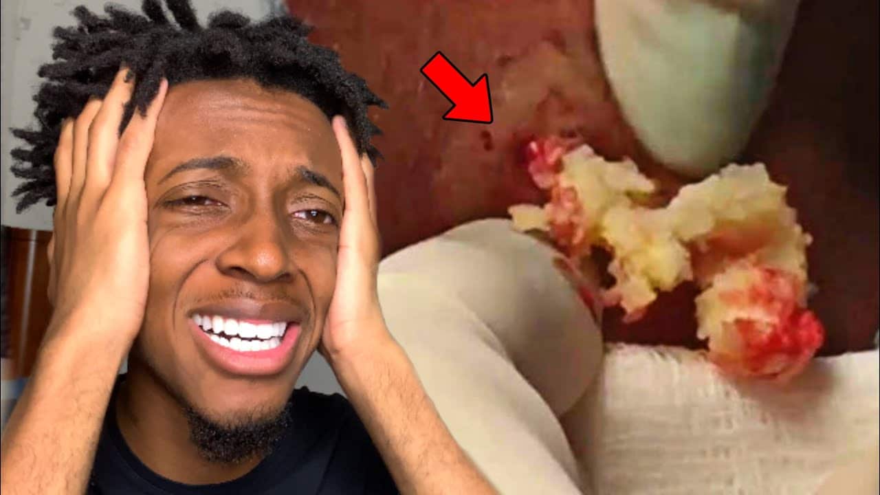 REACTING TO PIMPLE POPPING!!