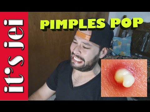 REACTING TO PIMPLES POPPING VIDEOS | it's jei