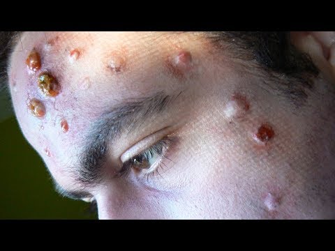 REAL Cystic Acne?  Pimple Popping Extravaganza!