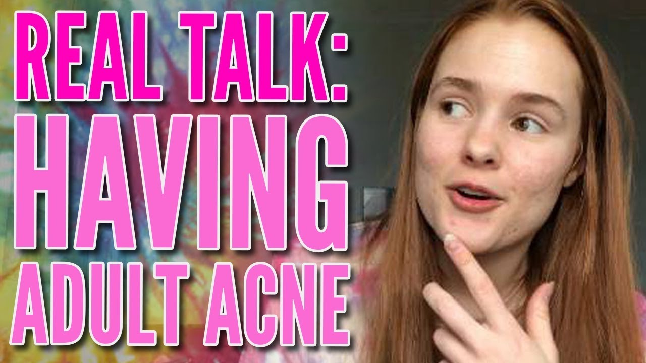 Real Talk: What it’s Really Like Having Adult Acne