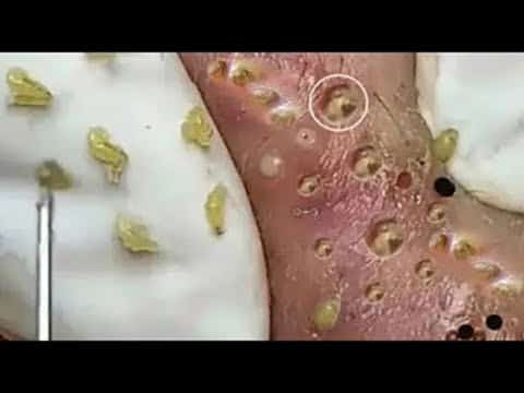 REALLY INTERESTING WITH VIDEO ACNE TREATMENT | BLACKHEADS REMOVAL | PIMPLE POPPING
