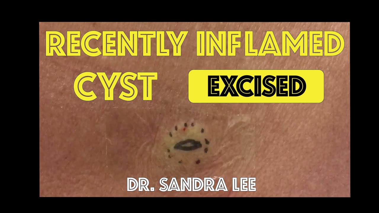 Recently inflamed cyst on the back, excised