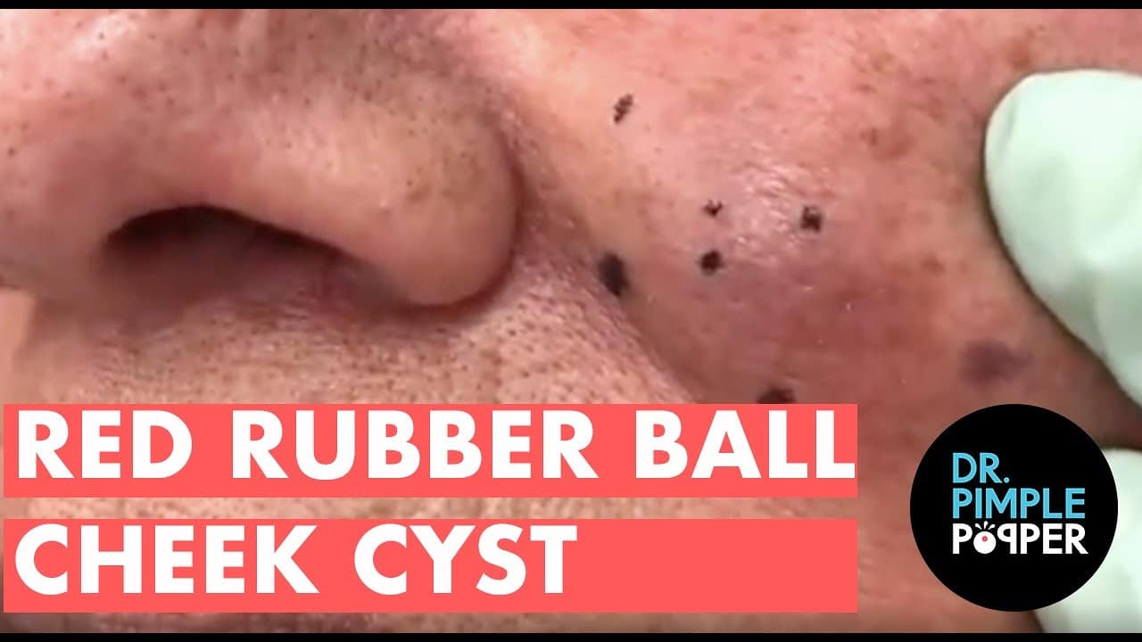 Red Rubber Ball Cheek Cyst