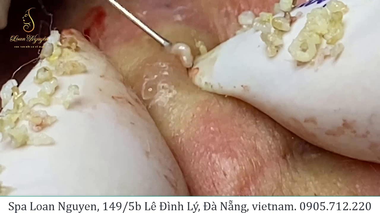 Relax with good videos on getting rid of acne (205) | Loan Nguyen