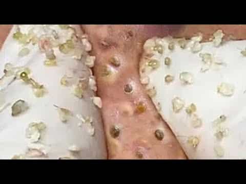 RELAX WITH INTERESTING VIDEO ACNE TREATMENT | BLACKHEAD REMOVAL | PIMPLE POPPING