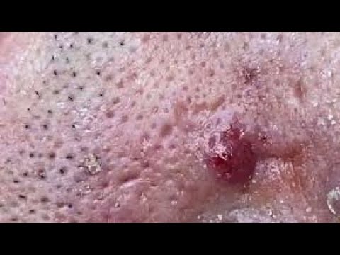 Relaxing Compilation of Pimple Popping