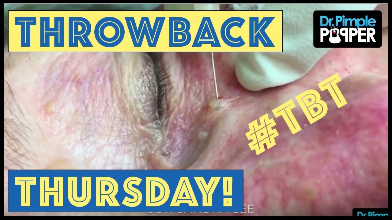 Reminiscing with Dr. Pimple Popper – TBT