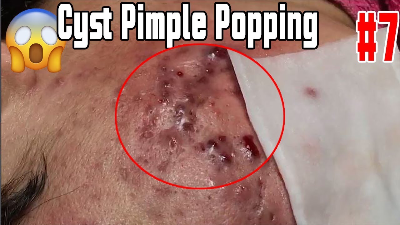 Removal Cyst Pimple Popping  | Part7