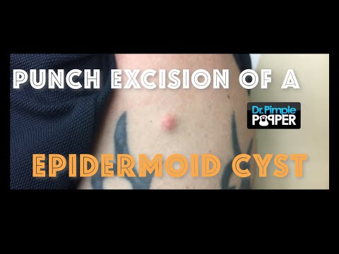 Removal of a cyst on the anterior shoulder