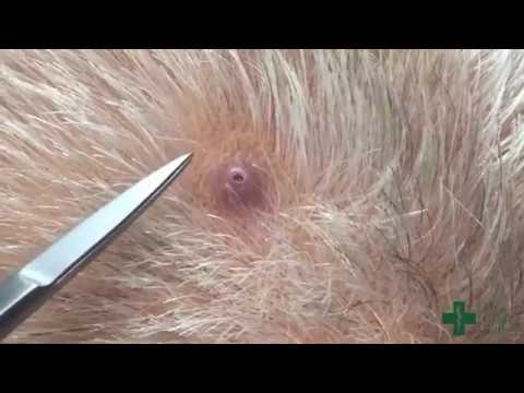 Removal of a small pilar cyst using a punch biopsy