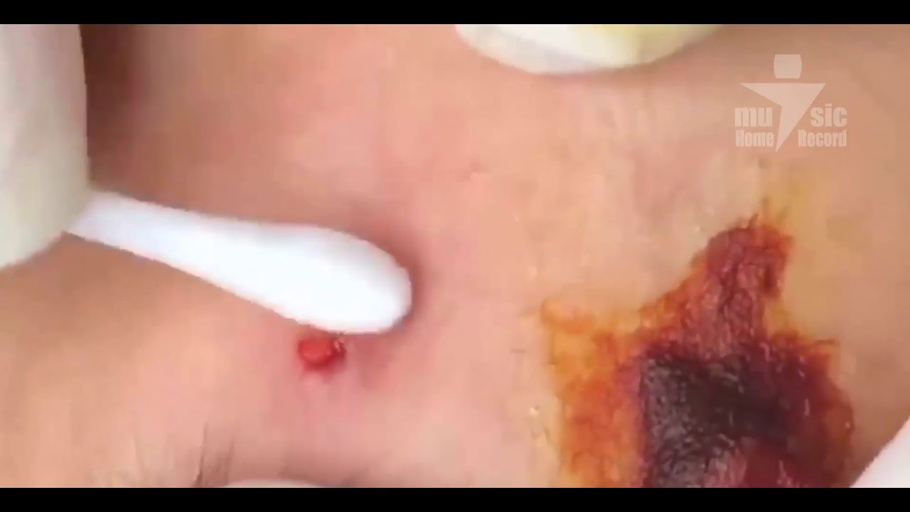 Removal of Cyst on the Forehead