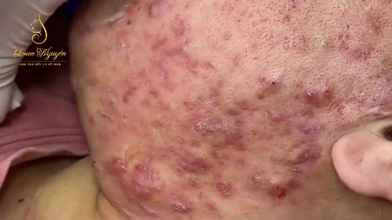 Remove inflammatory acne, pustules for young girls (215) | Loan Nguyen