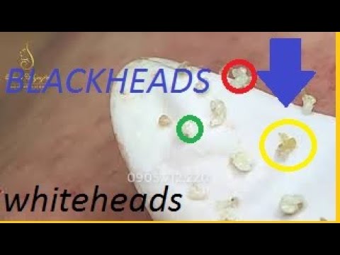 Remove lots of hidden PIMPLES, BLACKHEADS and WHITEHEADS for girls 30 | Loan Nguyen