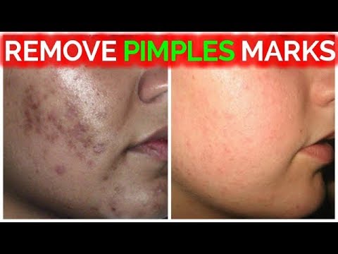 Remove Pimple Marks / Acne Marks / Dark Spots / Black Spots Fast At Home Remedies/ Rabia Skin Care