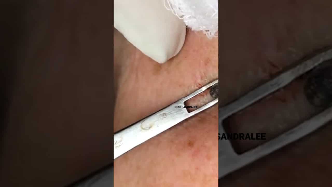 Removing a BIG Dilated Pore of Winer |Dr. Pimple Popper #shorts #drpimplepopper