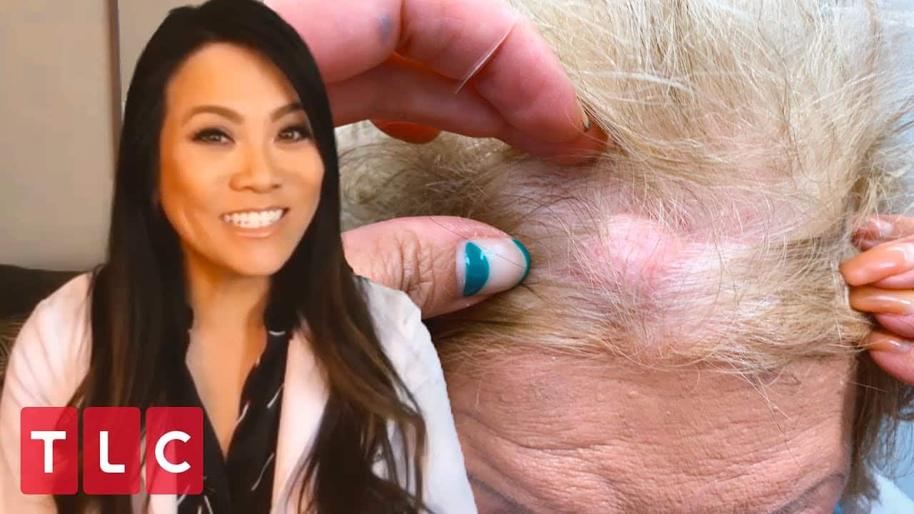 Removing a Boston Cherry Cyst! | Dr. Pimple Popper: This is Zit