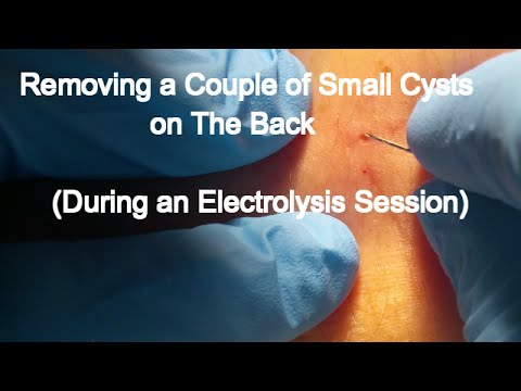 Removing a Couple of Small Cysts on The Back -During an Electrolysis Session-