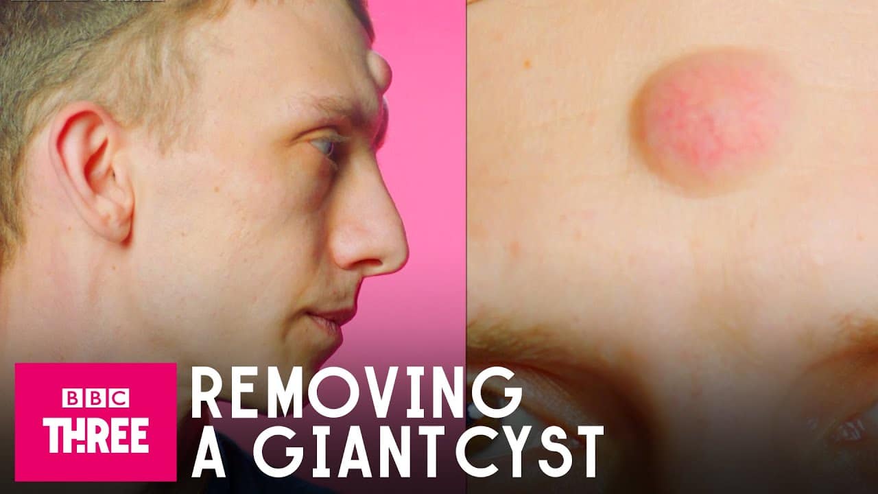 Removing A Giant Cyst: Skin