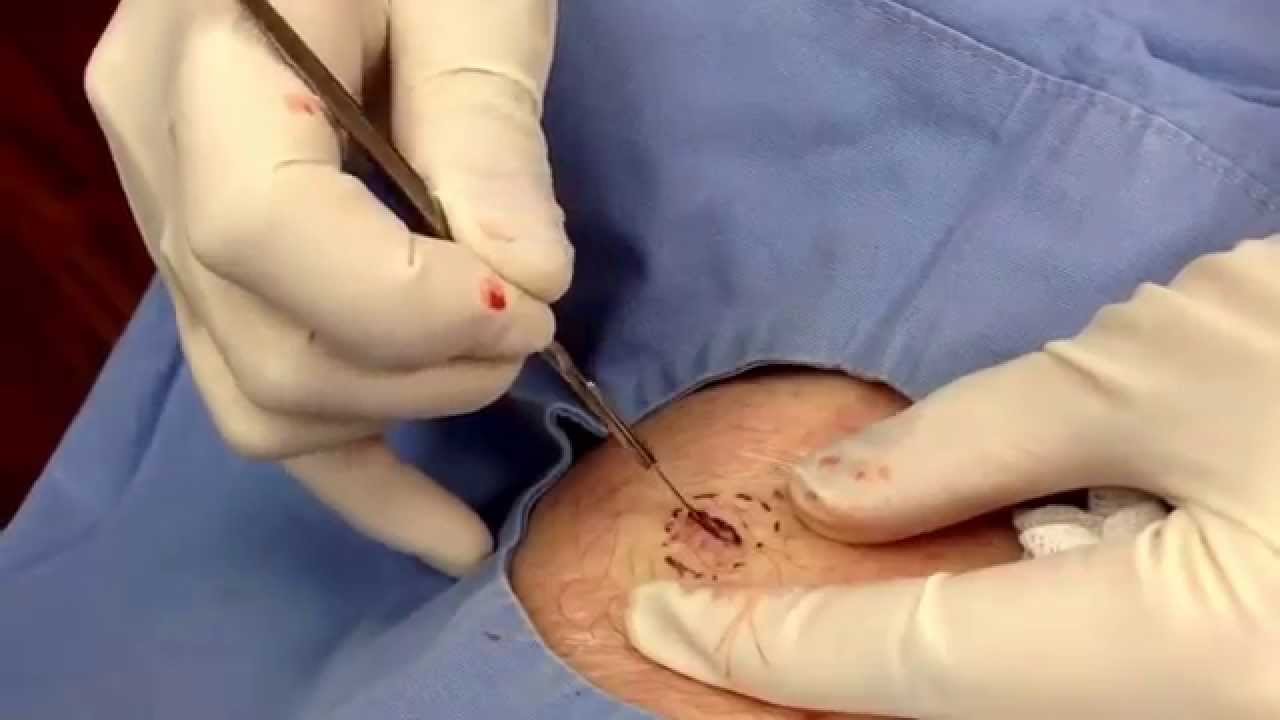Removing a lipoma from the arm and thigh. For medical education- NSFE.