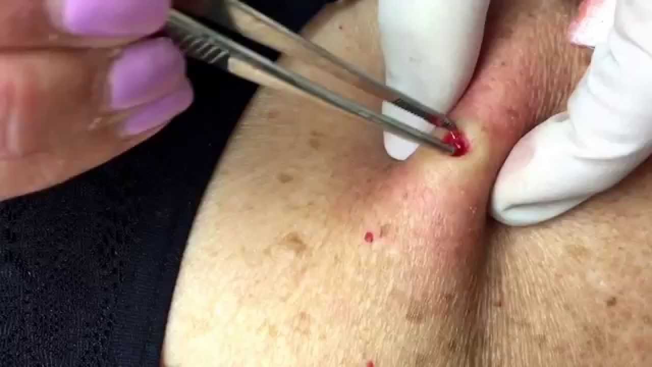 Removing a mole, then a punch excision of a cyst on the back. For medical education- NSFE.