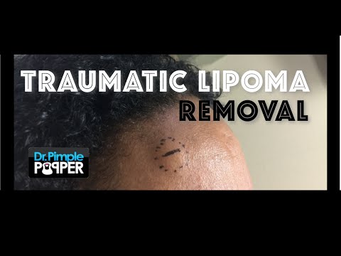 Removing a probable “traumatic lipoma” on the forehead