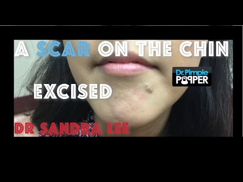 Removing a scar/ mole from the chin.
