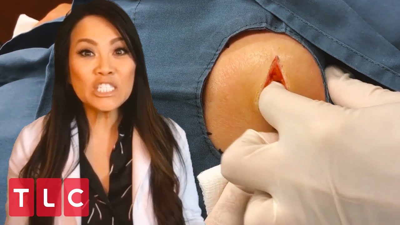 Removing a Six-Year-Old Lipoma! | Dr. Pimple Popper: This is Zit