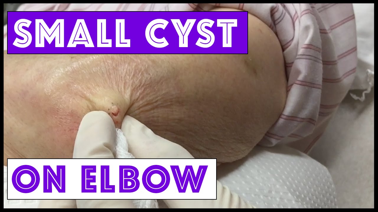 Removing a Small but Annoying Cyst on the Elbow, & Back Blackheads