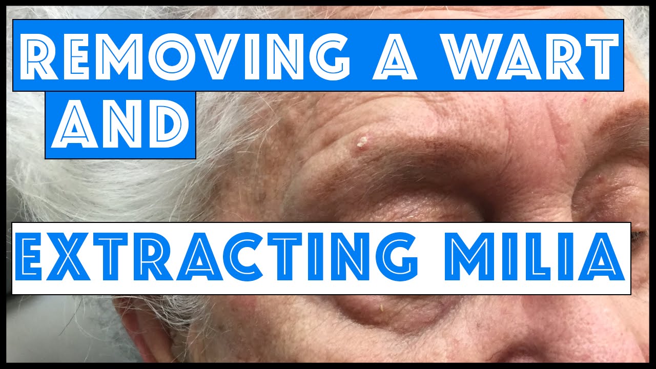 Removing a wart & extracting milia