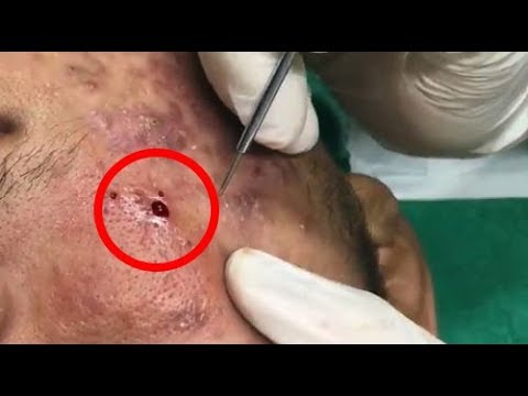 Removing Blackheads, Whiteheads, pimple popping