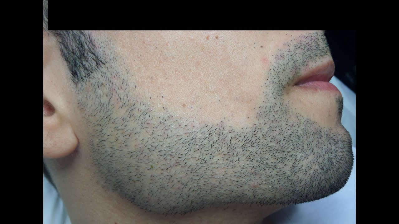 Removing Male Facial Hair – Hair REDUCTION in the BEARD.