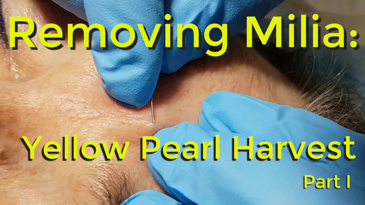 Removing Milia:  Yellow Pearl Harvest – Part I