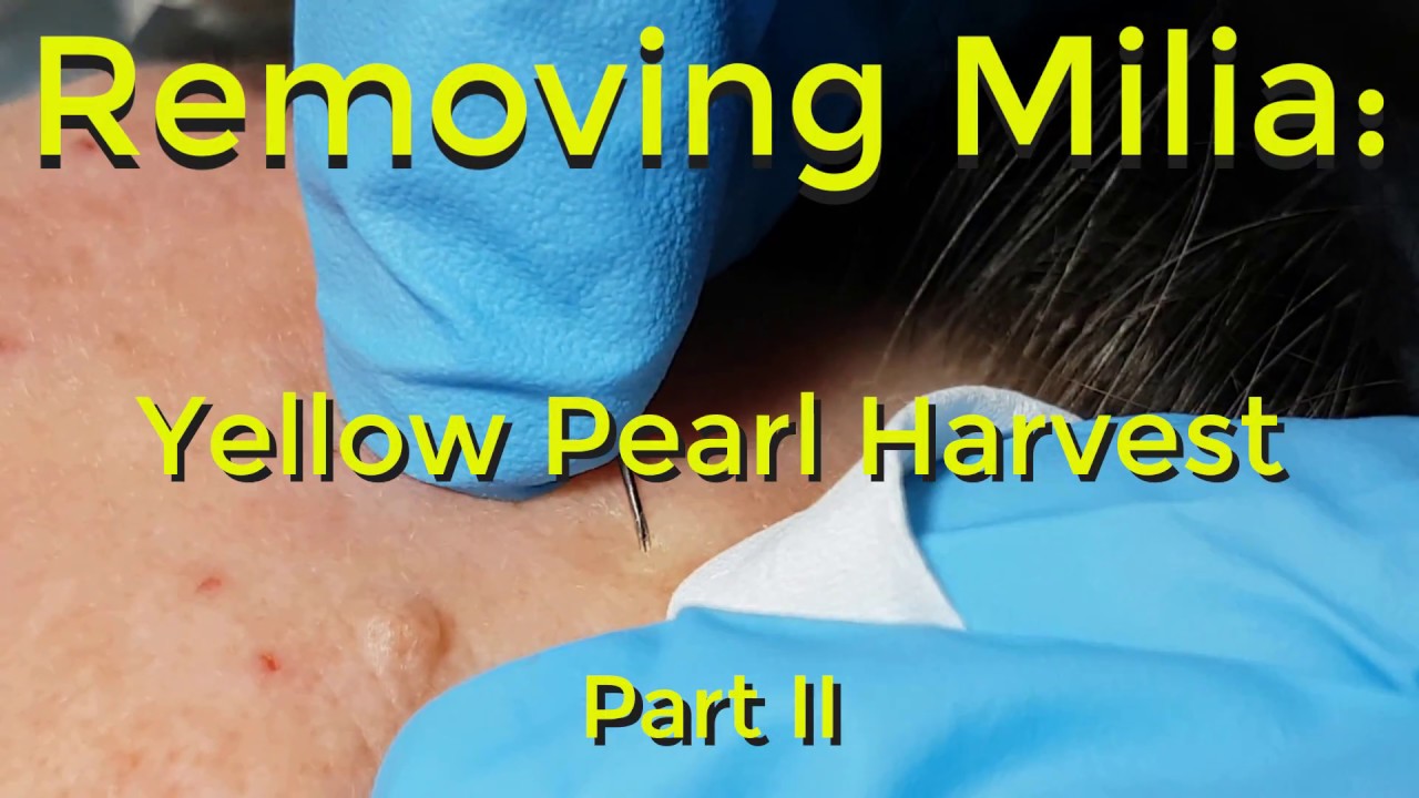 Removing Milia: Yellow Pearl Harvest – Part II