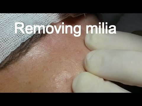 Removing Milia