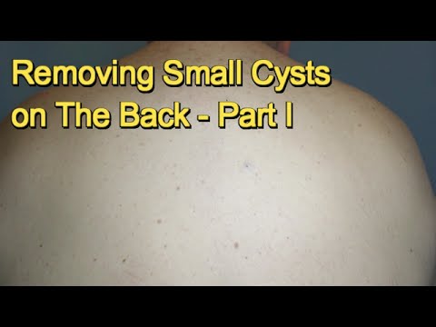 Removing Small Cysts on The Back –  Part I