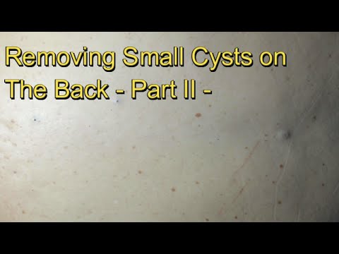 Removing Small Cysts on The Back:  – Part II