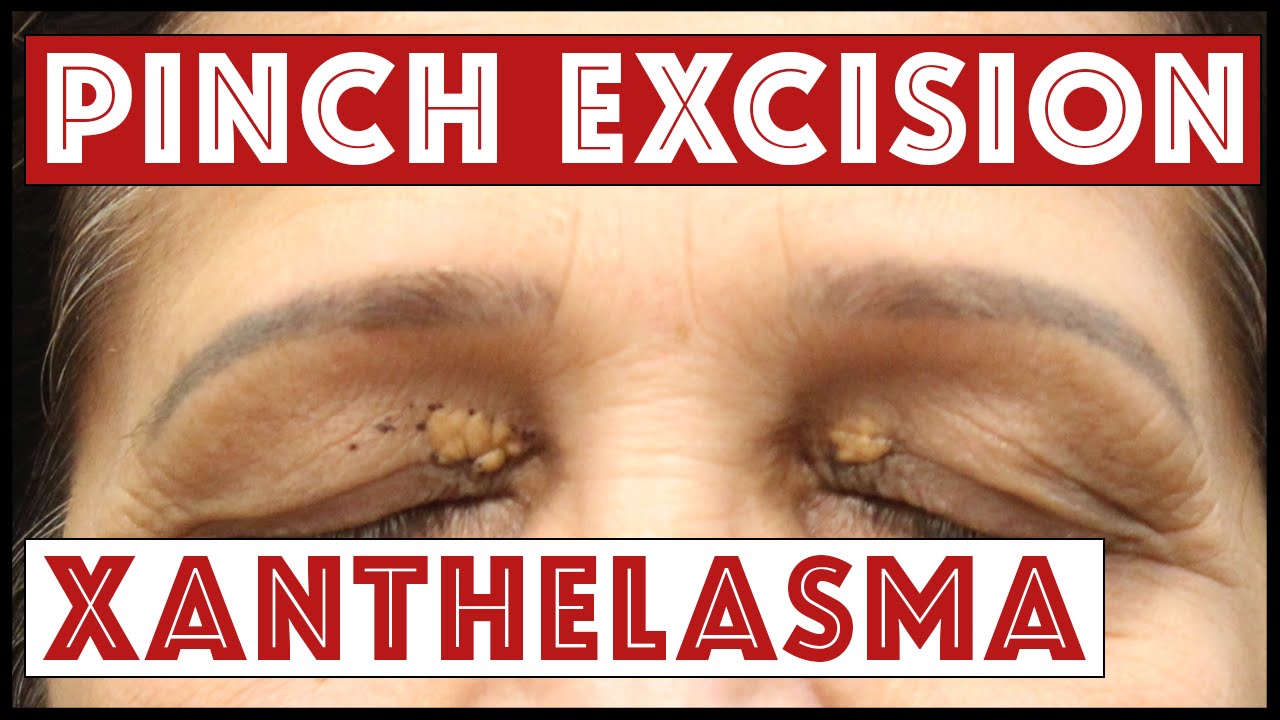Removing Xanthelasma on the Upper and Lower Eyelids