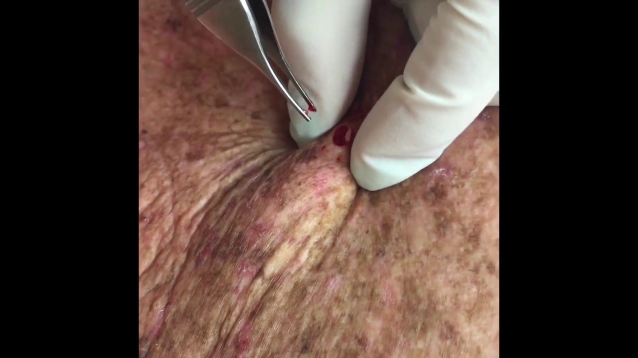 Repost of: Another method to pop out a cyst. For medical education- NSFE.