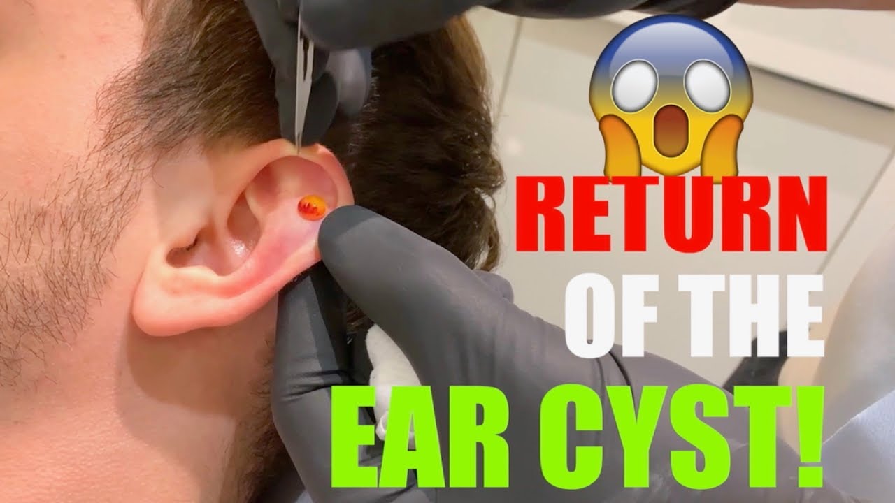 RETURN OF THE EAR CYST! ?