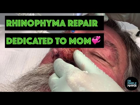 Rhinophyma Repair, Dedicated to MOM 💞