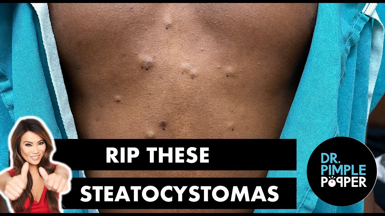 RIP These Steatocystomas