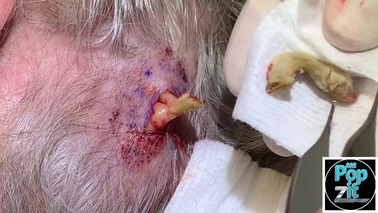 Ripe Banana Pilar Cyst. Same scalp as the yellow eel cyst. Full excision and closure. MrPopZit