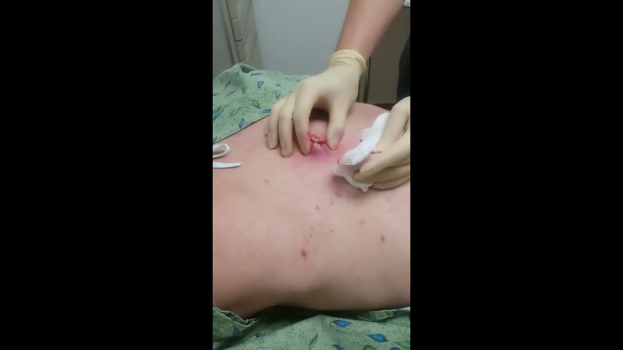 Robin’s Cyst Removal