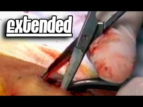 Rocket Back Cyst – Extended Edition by Request