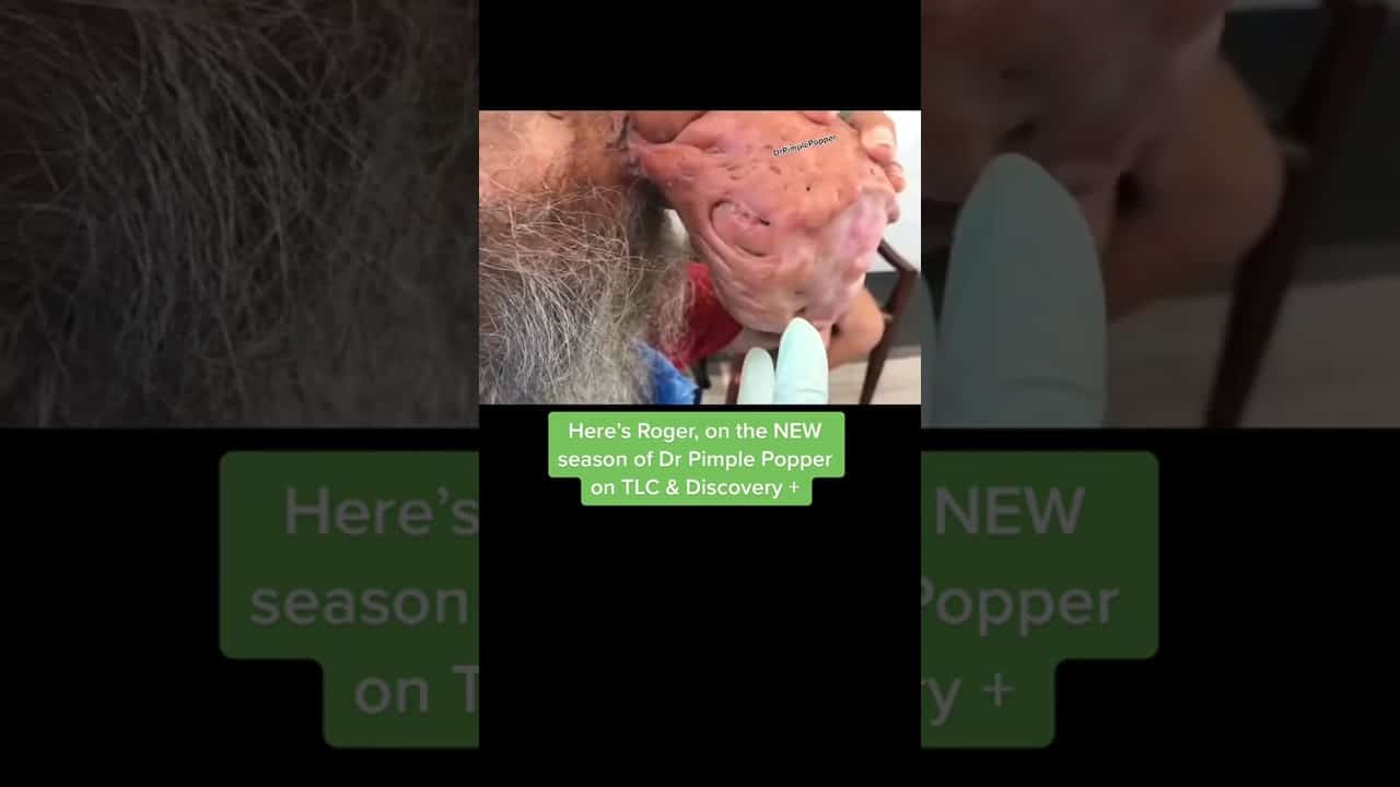 Roger’s Rhinophyma EXTRAS w/ Dr. Pimple Popper #shorts #drpimplepopper