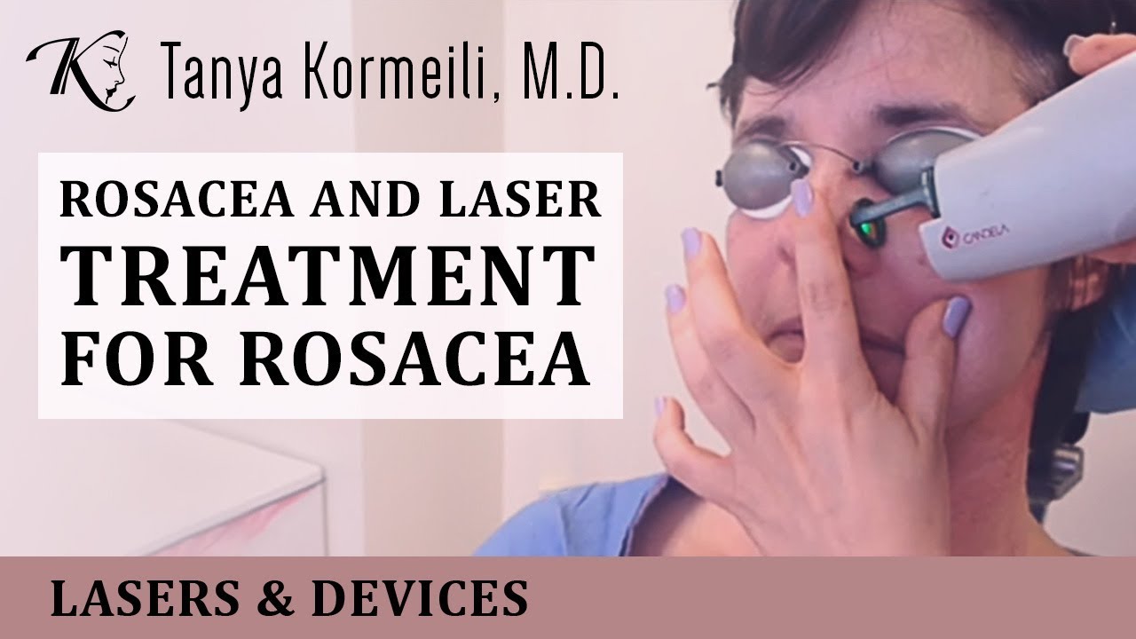 Rosacea and laser treatment for rosacea
