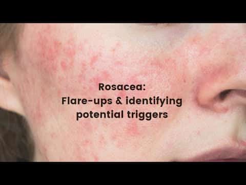 Rosacea flare ups and identifying potential triggers